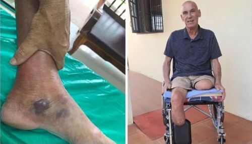 ซ้าย: ภาพเท้าของ Ed Olieslagers เมื่อเขามาถึงโรงพยาบาล ขวา: เอ็ดที่ขาของเขาถูกตัดเพื่อรักษาชีวิตใน 4 เดือนต่อมา
